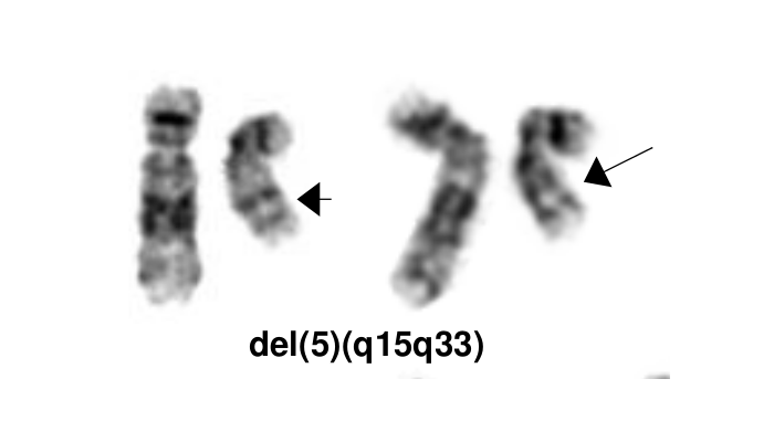 del(5)(q15q33)